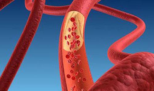 胆固醇高有什么症状 胆固醇高有什么症状表现