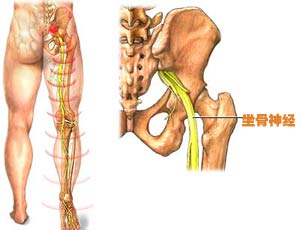 坐骨神经痛的症状 坐骨神经痛的症状图片