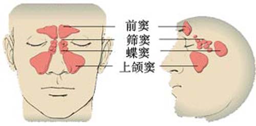 副鼻窦炎是什么 轻度副鼻窦炎是什么