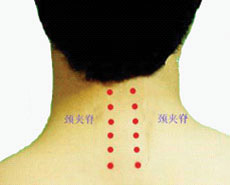 颈椎病针灸穴位图 颈椎病针灸位置图片