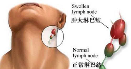淋巴瘤早期症状 淋巴瘤早期症状一般持续多久