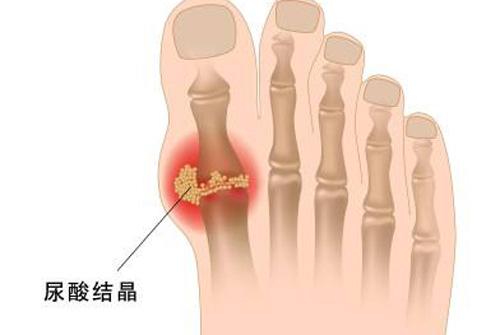 尿酸不高了脚趾关节痛 尿酸不高但是脚趾关节一直疼痛