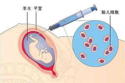 羊水穿刺什么时候做（羊水穿刺什么时候做比较好）