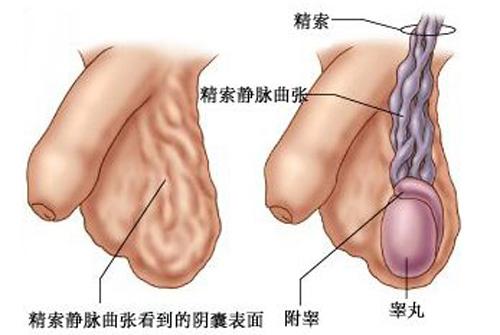 睾丸静脉曲张会疼吗（睾丸精索静脉曲张会疼吗）