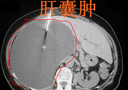 肝囊肿是怎么回事（肝囊肿是怎么回事?）