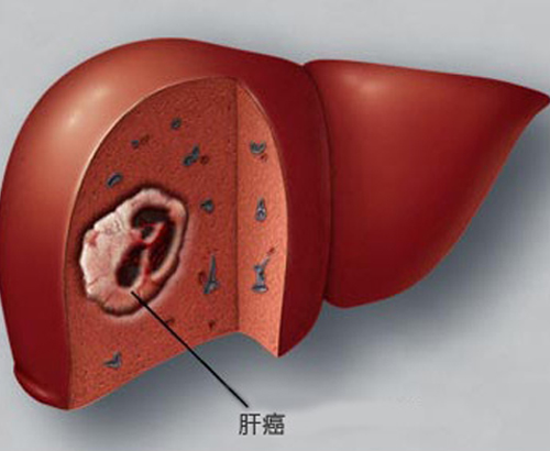 肝癌的早期症状 肝癌的早期症状和前兆