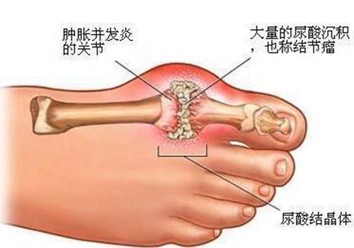 痛风用什么泡脚最好 这些痛风泡脚中药是最有效的方法