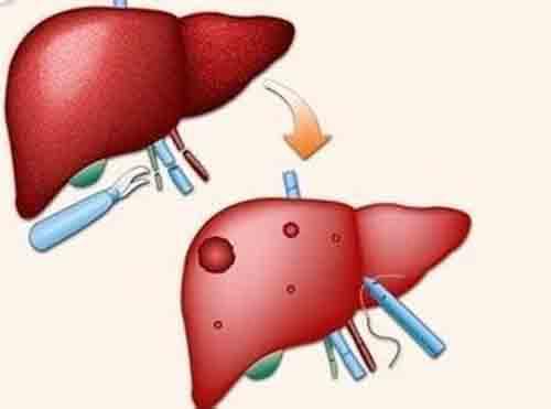 肝癌的晚期症状 肝癌的晚期症状和前兆都有哪些