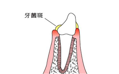 牙周炎是什么原因引起的 智齿牙周炎是什么原因引起的