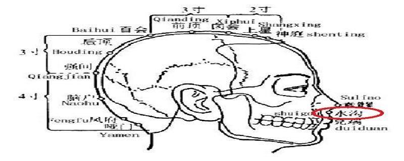 水沟的针刺方法（针刺水沟的作用与好处）