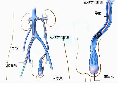 老怀不上竟是因为精索静脉曲张（为什么精索静脉曲张会导致不孕）