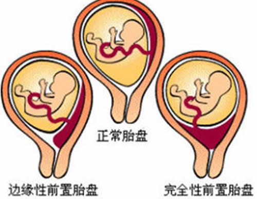 前置胎盘是怎样造成的（前置胎盘是怎样造成的呢）