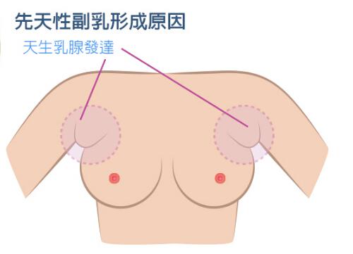 副乳的危害