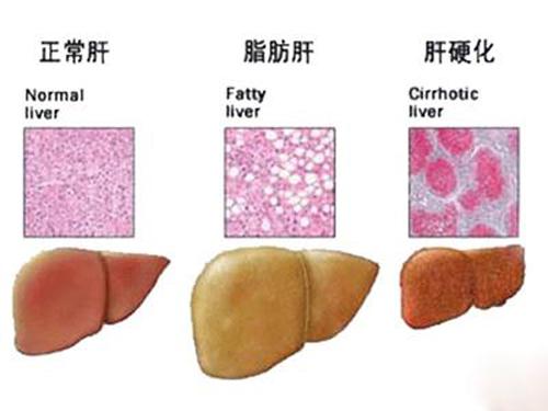 脂肪肝患者注意事项（脂肪肝患者需要注意什么）