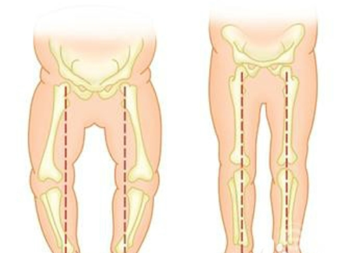 婴儿O型腿如何判断（如何判断婴儿是不是o型腿）
