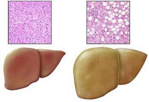 脂肪肝的危害及防治 脂肪肝危害性