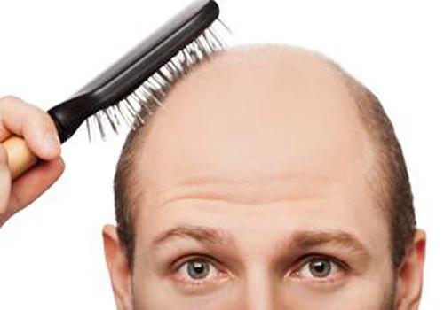 男性脱发是什么原因引起的（男性脱发是什么原因引起的怎么办）