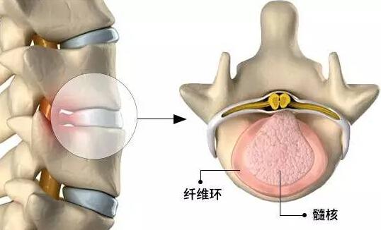 关于椎间盘突出，你必须知道的知识（关于椎间盘突出,你必须知道的知识有哪些）