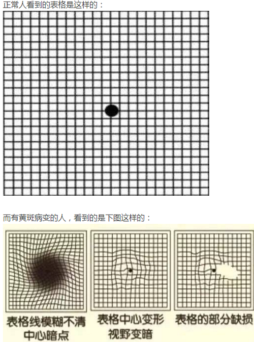 眼睛看东西变形扭曲是什么原因（眼睛看东西变形扭曲是什么原因?cot正常）