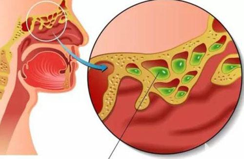 鼻窦炎有哪些症状（鼻窦炎有哪些症状用什么药）