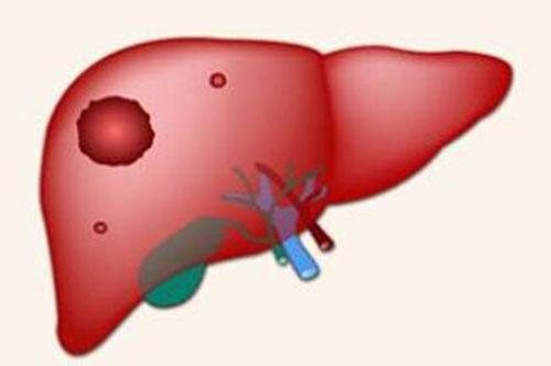 肝癌有哪些典型的症状 肝癌有哪种症状