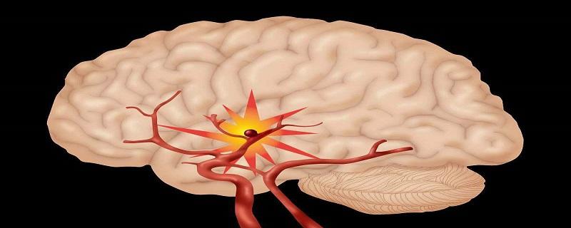 脑干出血的原因是什么 脑干出血的常见原因