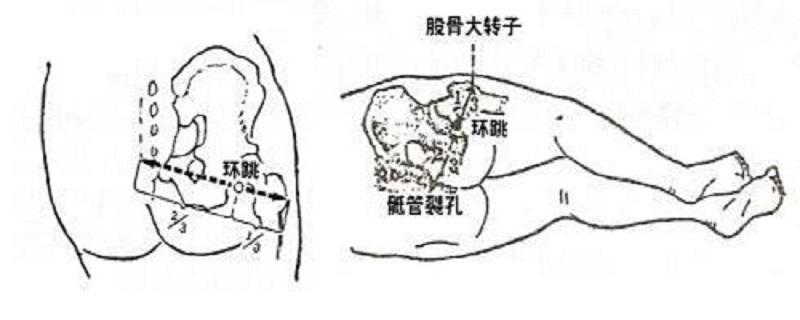 环跳的准确位置图视频 环跳的定位视频