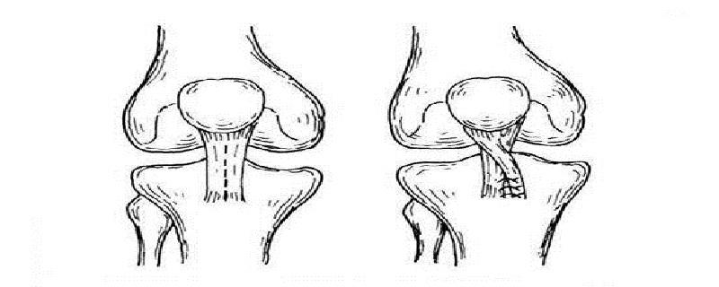 髌骨半脱位的原因（髌骨半脱位的原因及治疗）