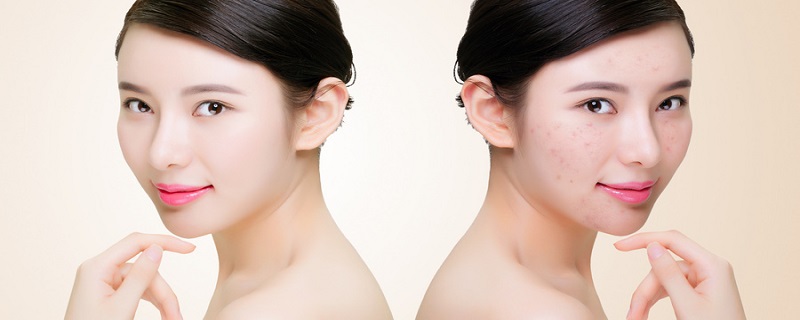 复因冷敷能长期使用吗 复因冷敷正确使用方法