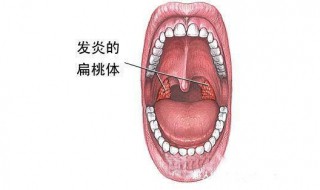 扁桃体发炎怎么办最简单的方法 扁桃体发炎可以尝试这样做