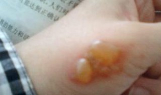 被水烫伤起泡不可以吃什么 被水烫伤起泡不可以吃什么食物