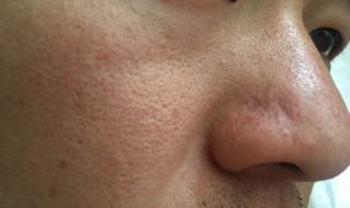 女人脸上毛孔粗大是什么原因（女人脸上毛孔粗大是怎样造成的）