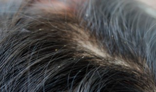 头皮屑多的原因（头皮屑多的原因与处理方法）