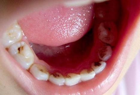 虫牙真的有虫吗 蛀牙是牙齿里有虫子吗
