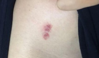 刚种的吻痕热敷还是冷敷（吻痕热敷还是冰敷）