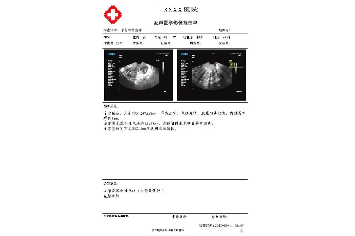 卵巢囊肿诊断证明图片（卵巢囊肿诊断证明图片高清）