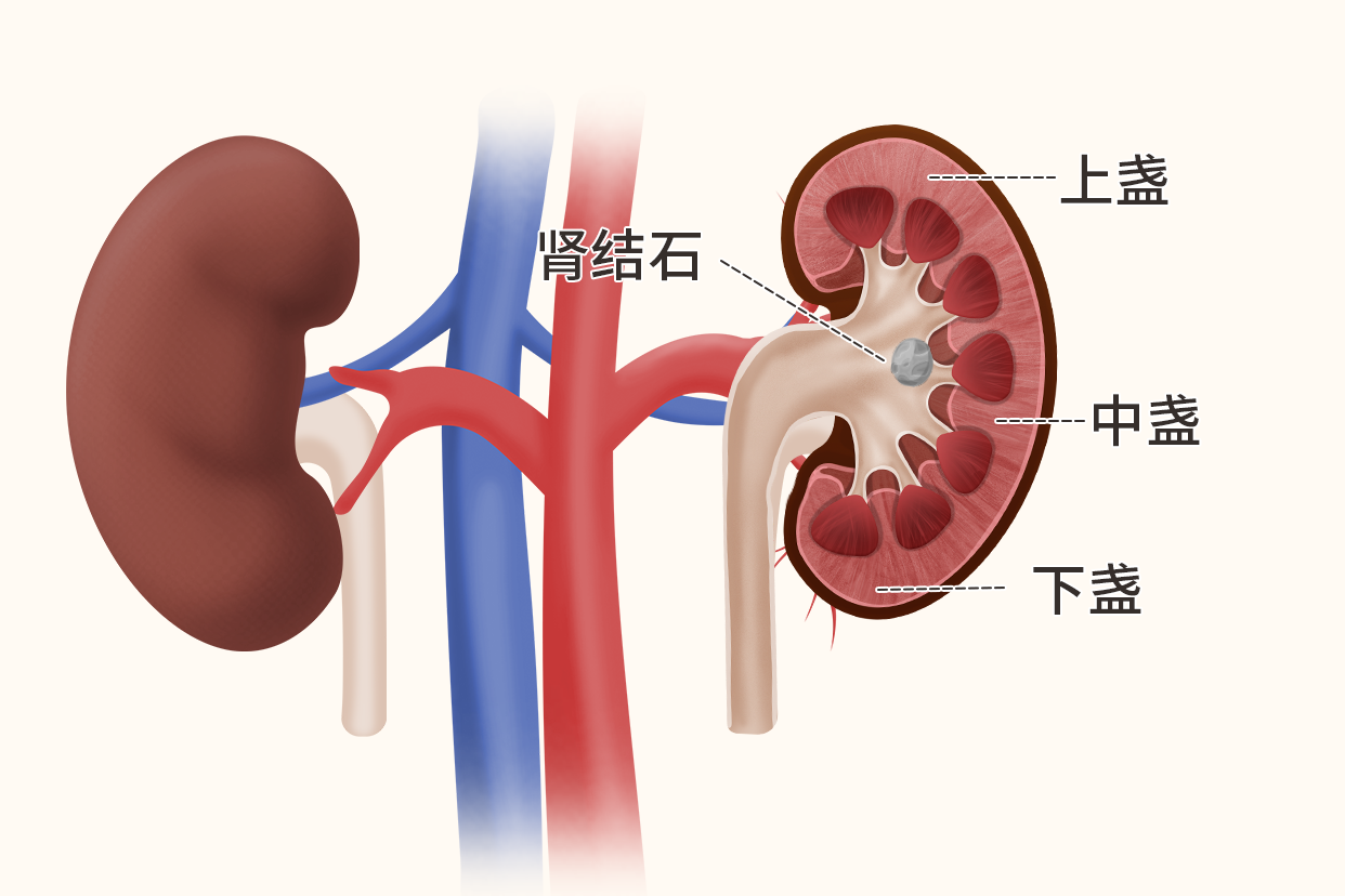 肾中盏结石图片（左肾中盏结石图片）