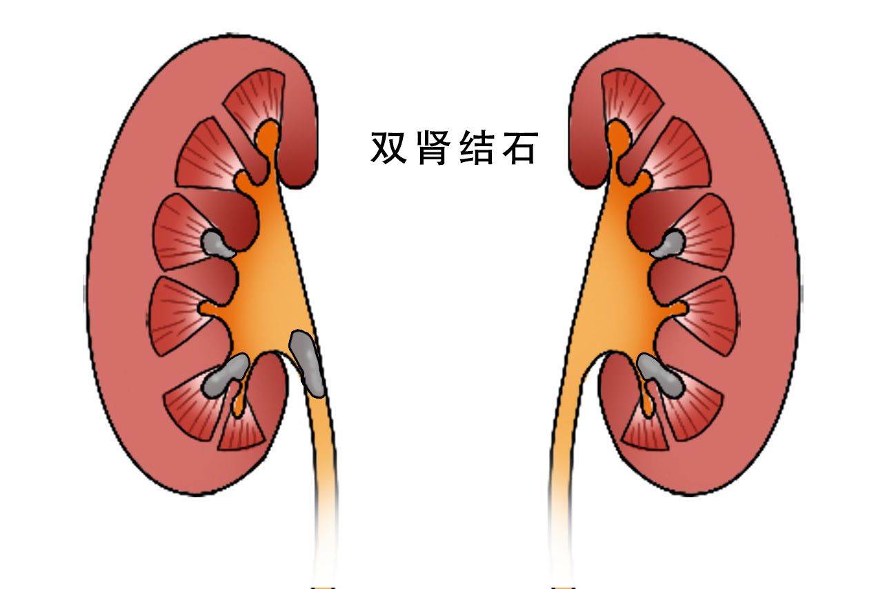 双肾结石图片（双肾结石图片大全）