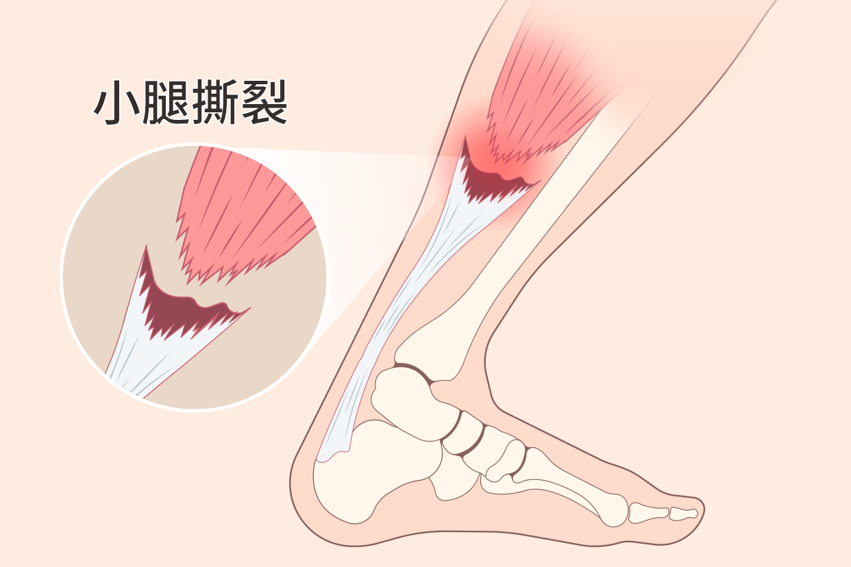 小腿肌肉撕裂图（小腿肌肉撕裂图片）