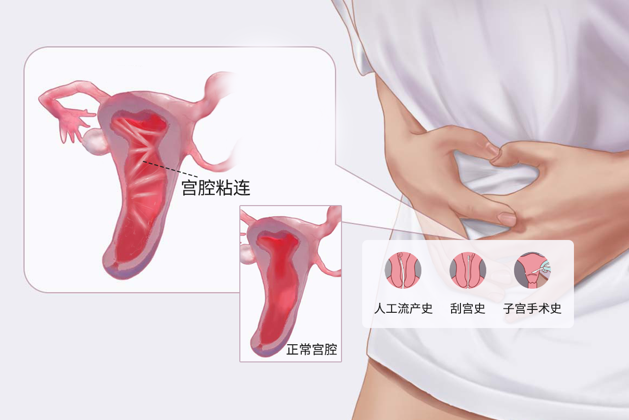 宫腔粘连和正常区别图 宫腔粘连和正常区别图片