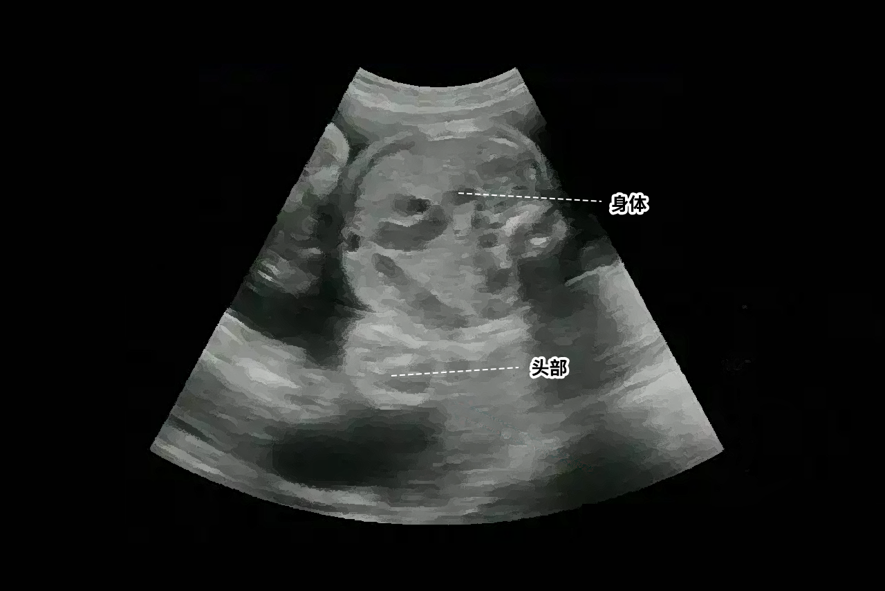 b超胎儿倒立着的图片（胎儿倒位图片）