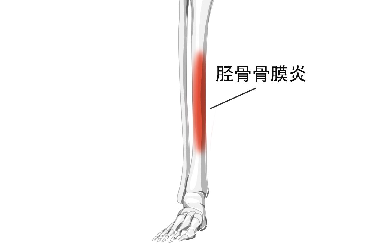 小腿胫骨骨膜炎图片（小腿胫骨骨膜炎图片大全）