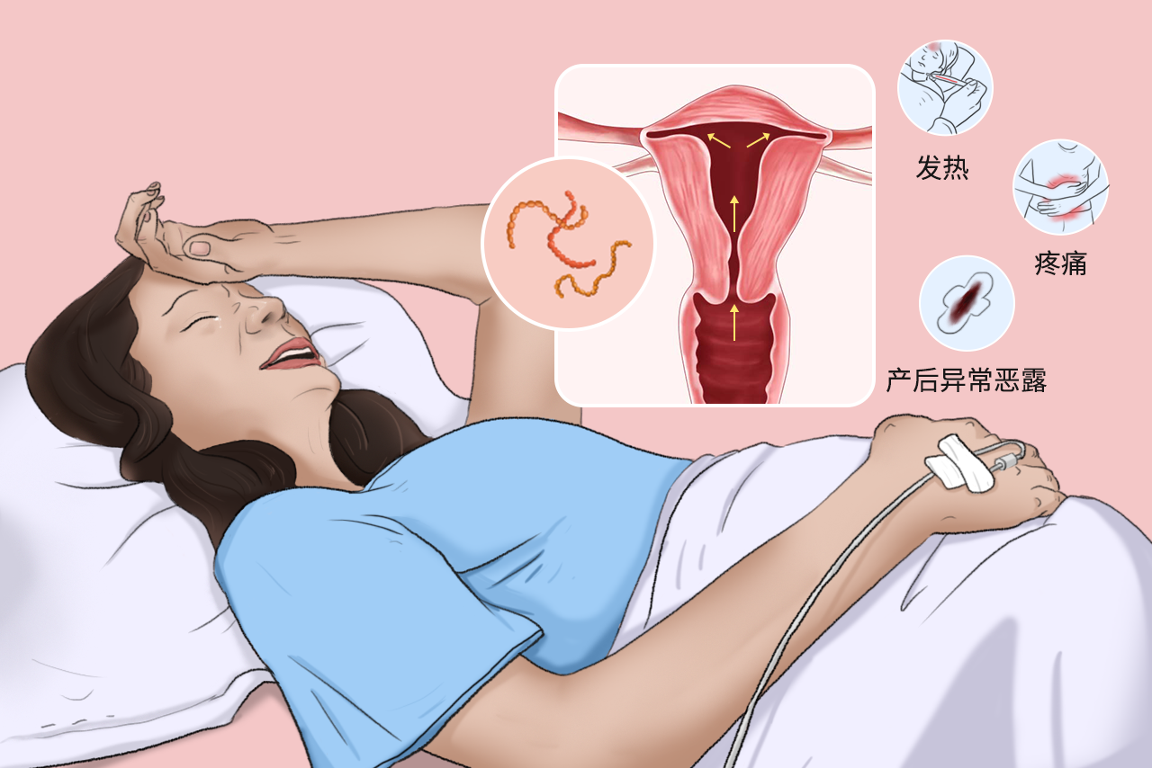 产褥感染的图片（产褥垫图片）