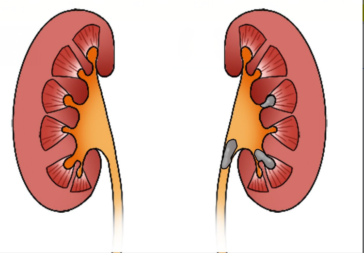 左肾结石图片（左肾结石图片女性）