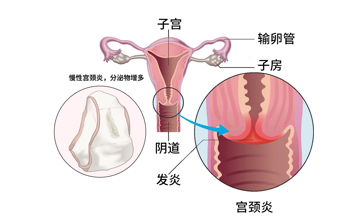 慢性宫颈炎内裤的图片