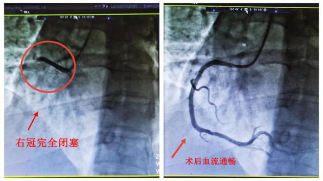 阳性一个月后，风险增加33倍！这些同时就医的肺梗心梗患者，竟都和出汗脱水有关