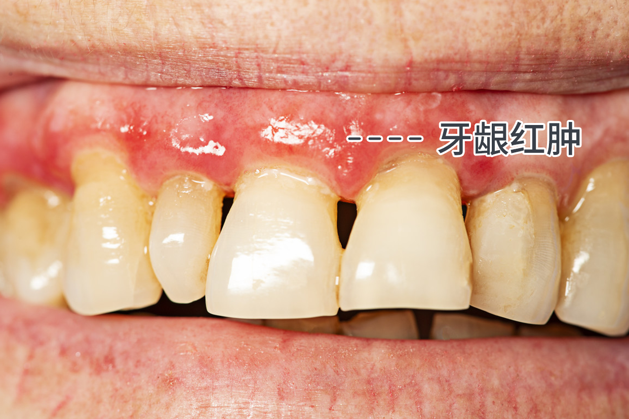 牙周炎牙龈红肿的图片（牙龈炎牙周炎症状图片）