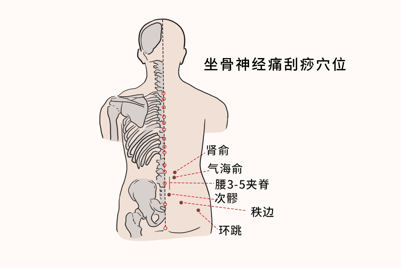 坐骨神经刮痧的方法示意图（坐骨神经刮痧手法视频）