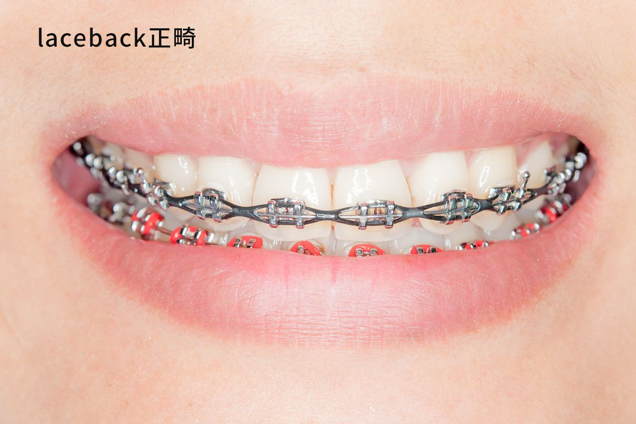 laceback正畸示范图（正畸tieback）