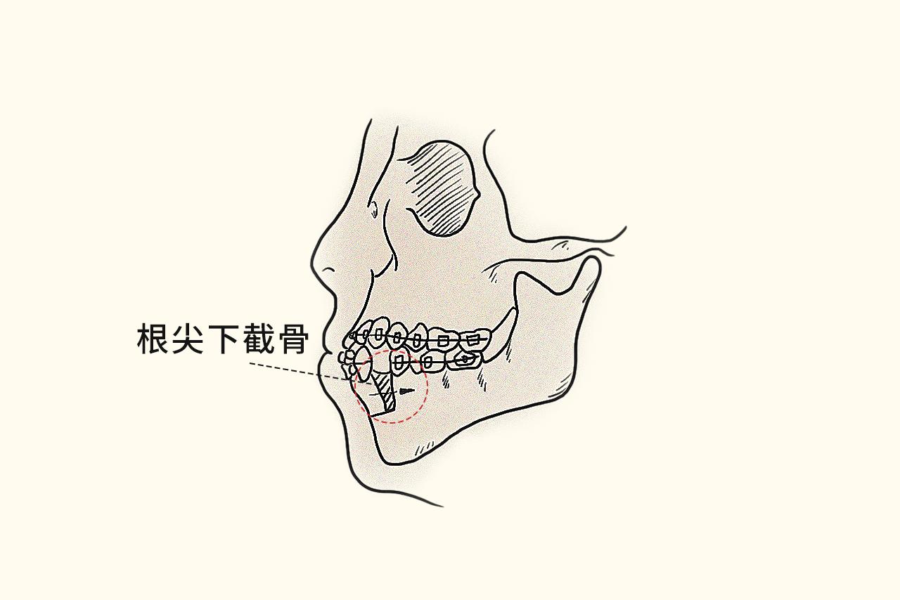 正颌手术根尖下截骨图解 正颌手术根尖下截骨图解视频